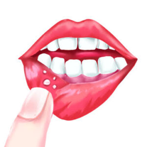 Mouth ulcers