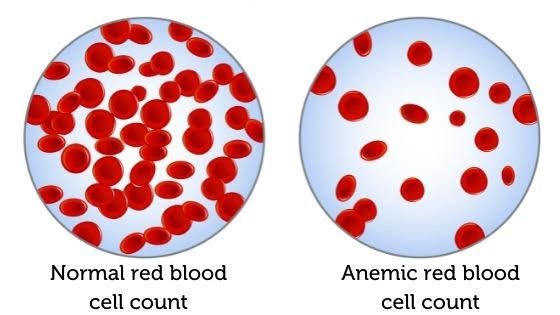 The most popular warning signs of nutritional deficiency is anemia