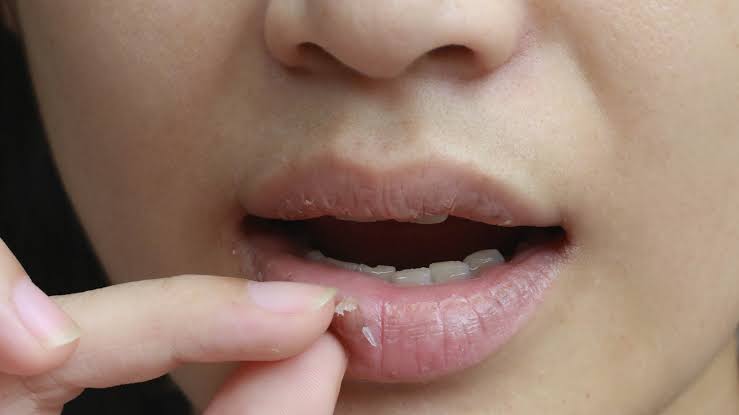 How to take care of dry lips in the winter 