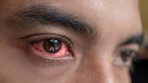 Conjunctivitis