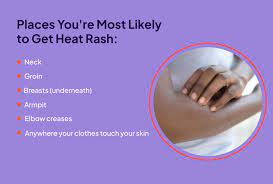 How to get rid of heat rash quickly 