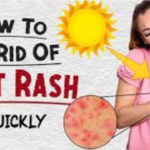 How to get rid of heat rash quickly