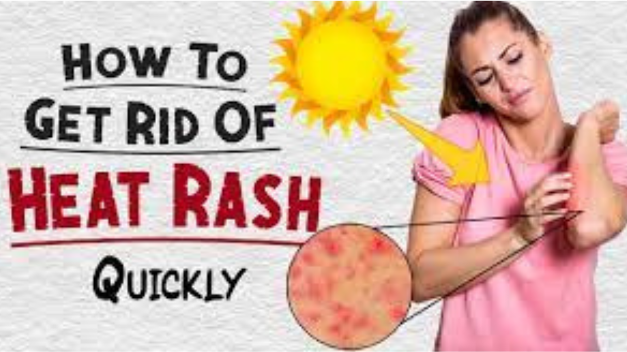 How to get rid of heat rash quickly