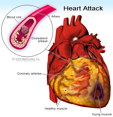 Reasons for heart attack in early age